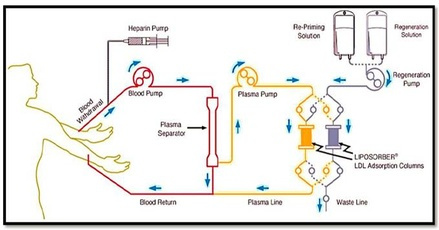 scheme-apheresis.jpg