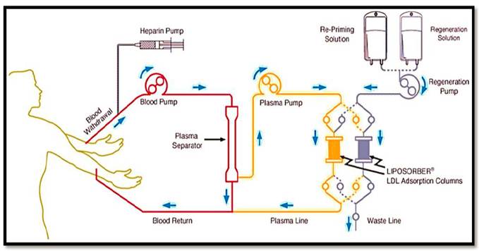 scheme-apheresis.jpg