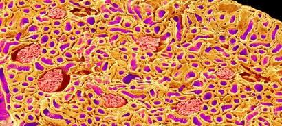 Genetical and biochemical profiling of renal disease