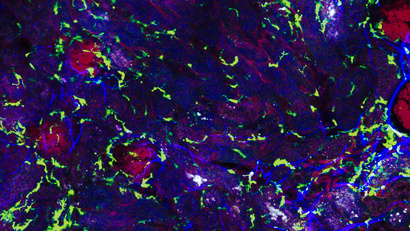 Inflammatory cells and glomerular injury