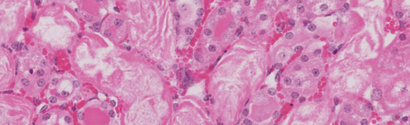Kidney degeneration and regeneration