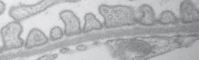 Podocyte ageing and Fabry’s disease