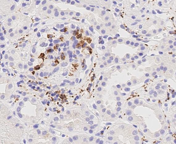 anti-68-monocyte-staining-of-a-human-fsgs-glomerulus.jpg